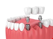 Southfield Dental: Dental Implants in Bournemouth