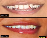 Teeth Cleaning In Ahmedabad